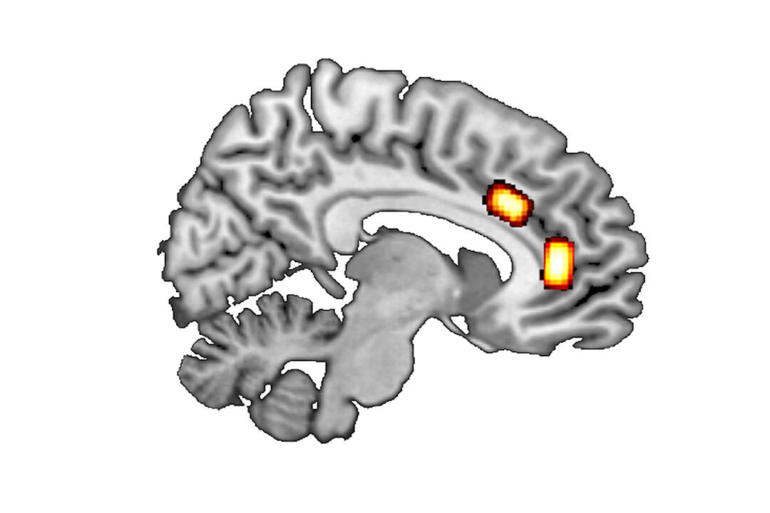 Schematischer Längsschnitt durch das Gehirn mit farbig markierten Bereichen, die bei unterschiedlichen Entscheidungsprozessen eine Rolle spielen.